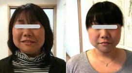 Small face correction treatment: confirmation of effect: Japan Small Face Correction School